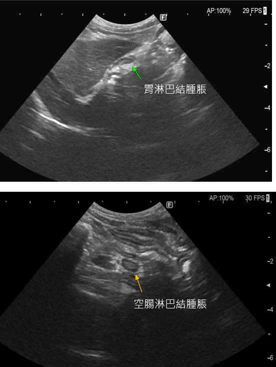 Diagnosis image with abdomen echo for FRE