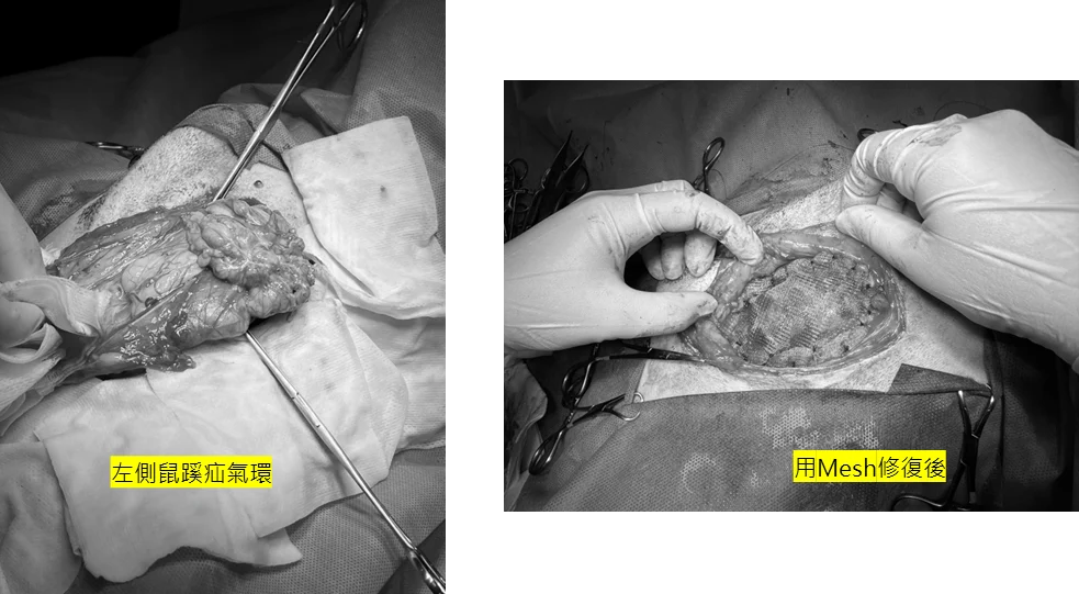 鼠蹊疝氣環 Mesh修復疝氣