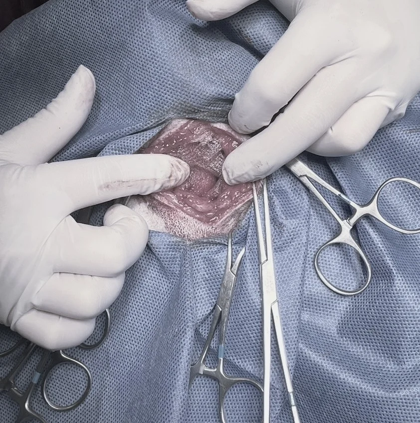 perineal_mesh